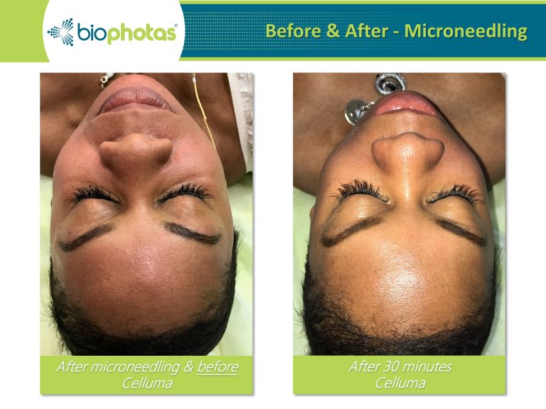 Before-After (1)