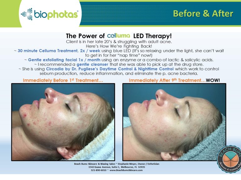 Before-After (10)