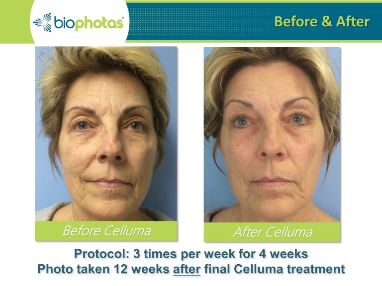 Before-After (11)