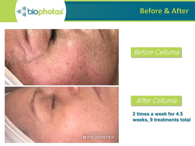 Before-After (19)