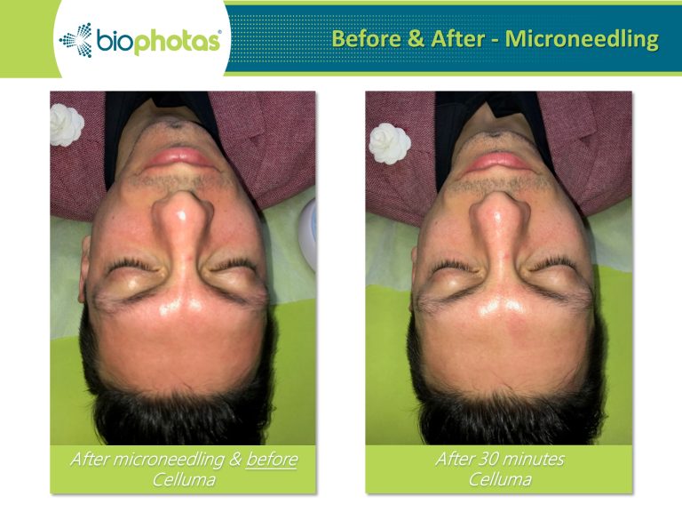 Before-After (2)