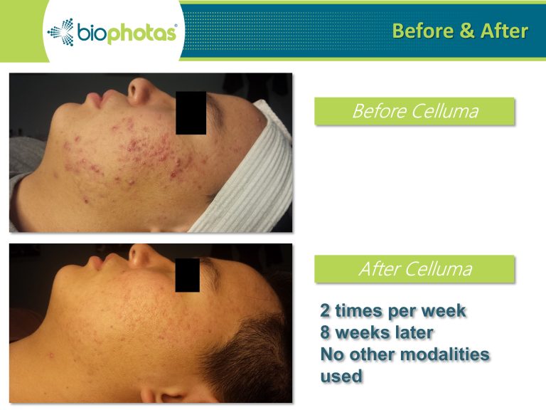 Before-After (4)